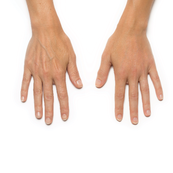 jackie-sqaure-about-hands Before and after comparison of Radiesse treatment for hands.