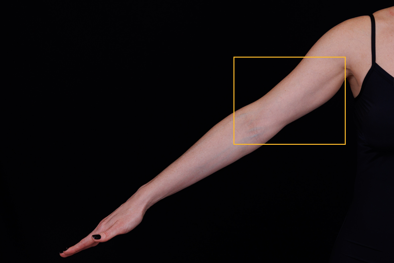 Results of Ultherapy treatment on arm