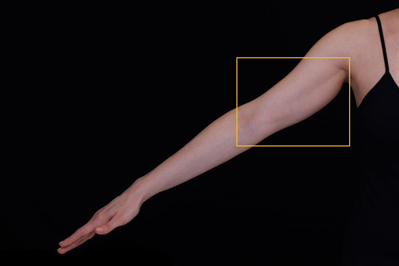 Before Ultherapy treatment on arm