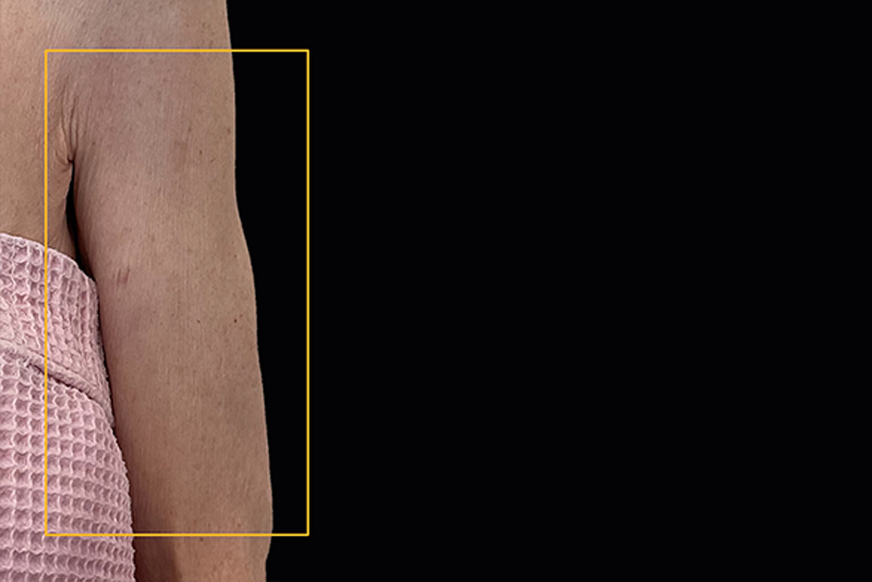 View from the front of right arm after Ultherapy treatment