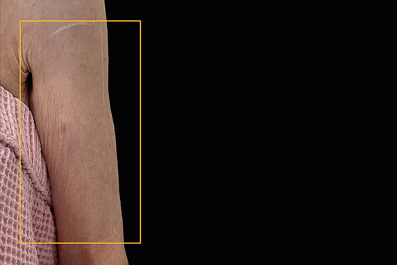 View from the front of right arm before Ultherapy treatment