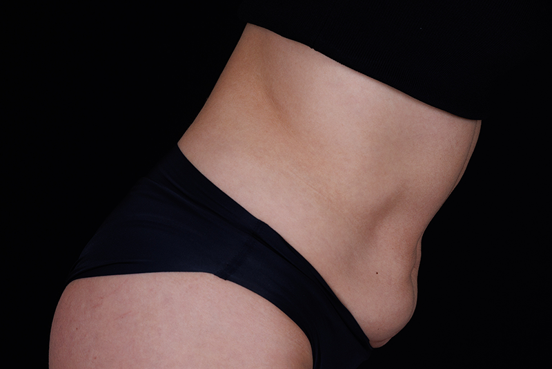 View from the side of abdomen after Ultherapy treatment