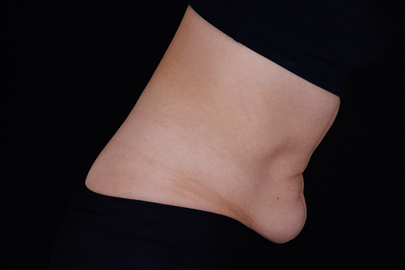 View from the side of abdomen before Ultherapy treatment