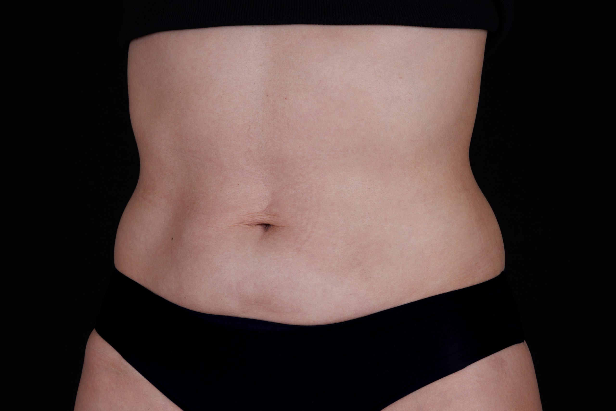 View from the front of abdomen after Ultherapy treatment