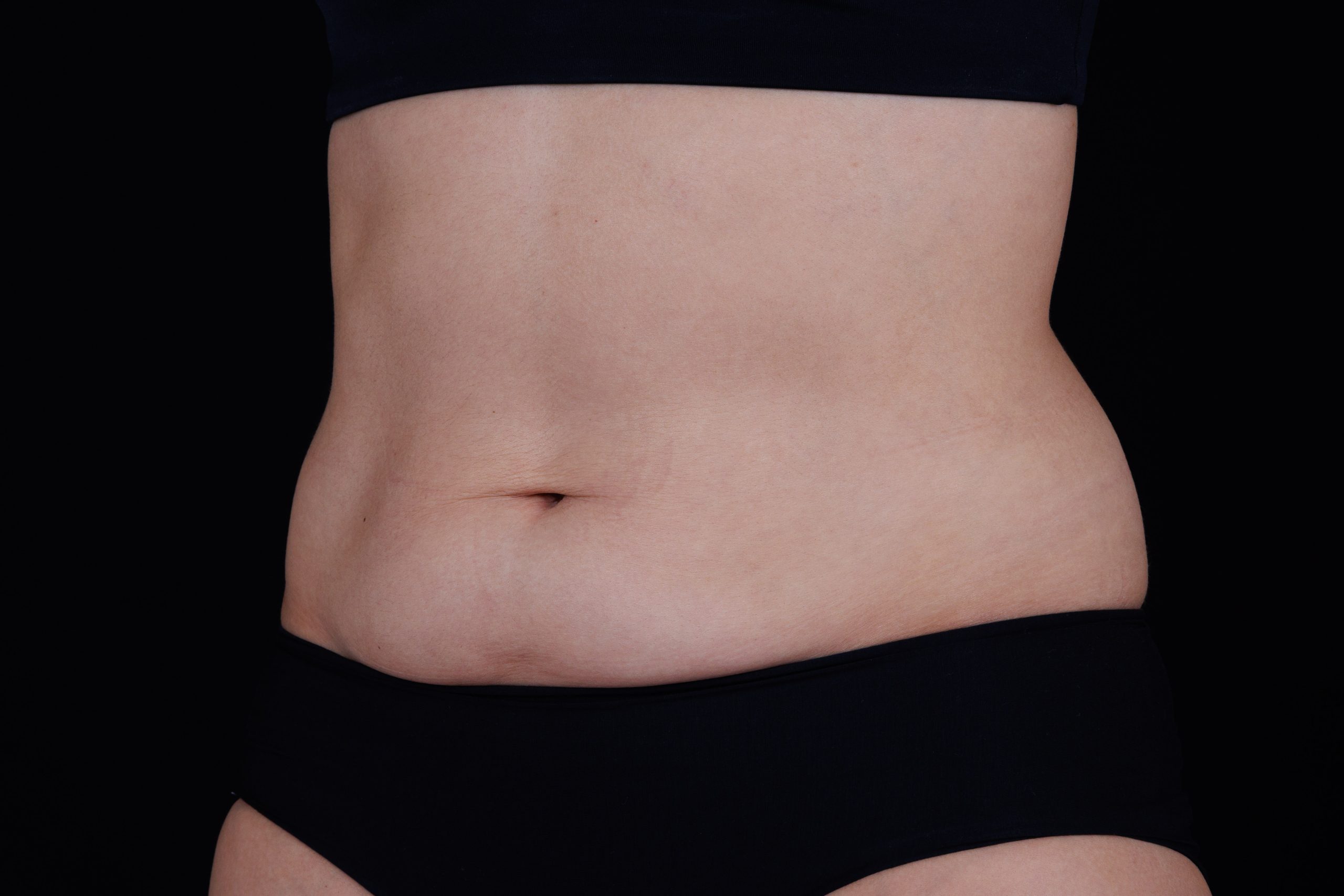 View from the front of abdomen before Ultherapy treatment